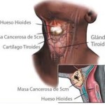 tiroides-carcinoma